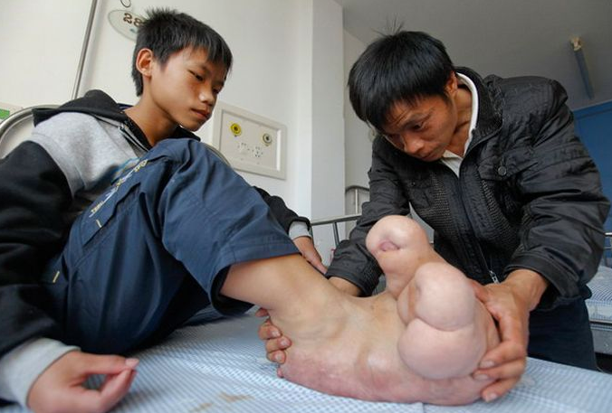 Мальчику-хоббиту с гигантскими ногами предстоит операция 14-летний китайски